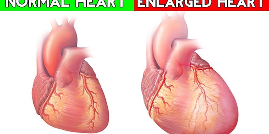 enlarged-heart